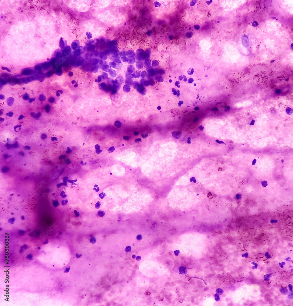 Poster CT guided FNA from lung lesion, Chronic granulomatous inflammation (CGI) with Tuberculosis. CGI-TB. smear show clusters of epithelioid cells, lymphocytes, histiocytes, giant cells and fibrous tissues.