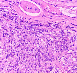 Bone cancer. Chondroblastic osteosarcoma. It's very rare cancer, microscopically show atypical...