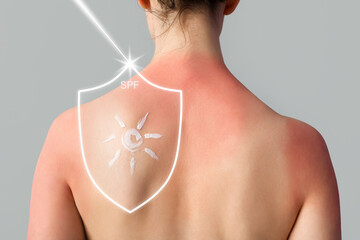 Allergic young woman with sunburned skin and sun made of cream on grey background, back view
