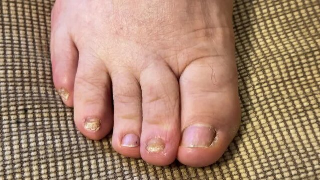 Fungus Onychosis infection of on nails of woman's toenail fungus. Close-up.