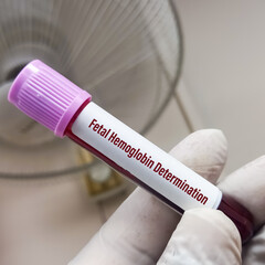 Blood sample for Fetal Hemoglobin Determination test to diagnosis of Fetomaternal Hemorrhage.