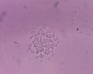 Microscopic fungi Malassezia furfur, showing yeast cells and hyphae. dermatophytes, Nail scraping...