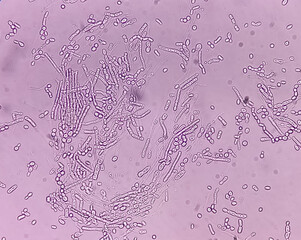 Microscopic fungi Malassezia furfur, showing yeast cells and hyphae. dermatophytes, Nail scraping...