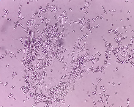 Microscopic fungi Malassezia furfur, showing yeast cells and hyphae. dermatophytes, Nail scraping or skin scraping for fungus test in microbiology laboratory.