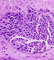 Urinary bladder cancer. Transitional cell carcinoma. show malignant neoplasm, 40x view.
