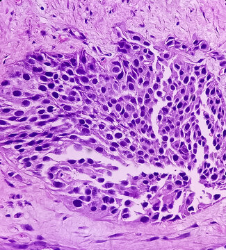 Urinary bladder cancer. Transitional cell carcinoma. show malignant neoplasm, 40x view.