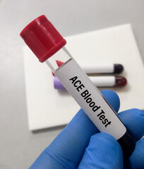 Blood test sample for Angiotensin-converting enzyme (ACE) test. diagnosis of sarcoidosis.