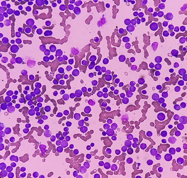 Acute myeloid leukemia (AML). Smear show monocytes and mostly blast cell. Anemia and thrombocytopenia. Most common acute leukemia affecting adults.