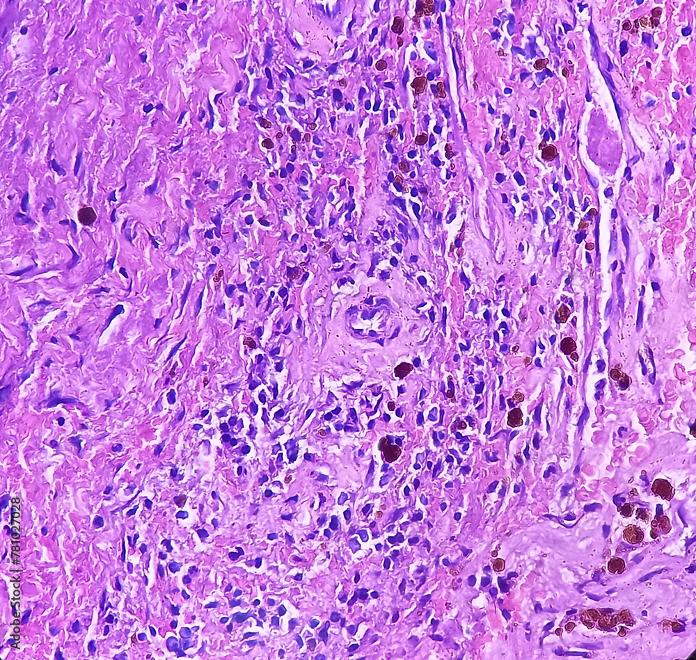 Sticker Oral submucous fibrosis (OSF), abnormal collagen deposition. precancerous disorder and transforms. Photomicrograph,