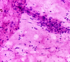 Neurofibromatosis. Neurofibroma (FNA Cytology), microscopic image show spindle shaped cells with...