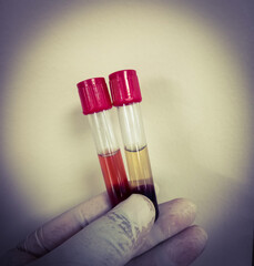 Hemolysis (abnormal) human or plasma in test tube on white background. Hemolysis sample can cause...