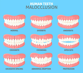 Different human teeth malocclusion types front view set