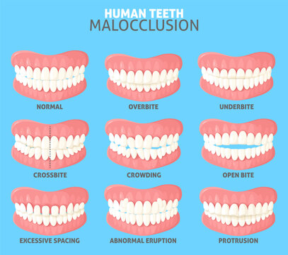 Different human teeth malocclusion types front view set