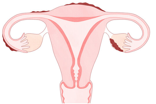 Blank endometriosis unlabeled diagram Human anatomy transparent PNG