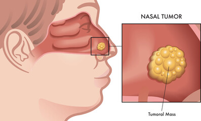 Medical illustration of a nasal tumor with a magnified detail.
