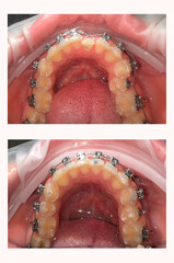 Close-up of installed braces on teeth. The effect before and after installing braces. Vertical photography.