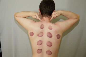 The back of a young man on a gray background with the effects of vacuum massage. Vacuum massage on...
