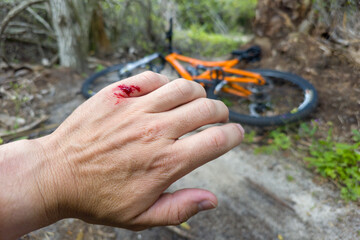 Mountain bike accident. Rider hand wound with red blood from hitting a tree stump
