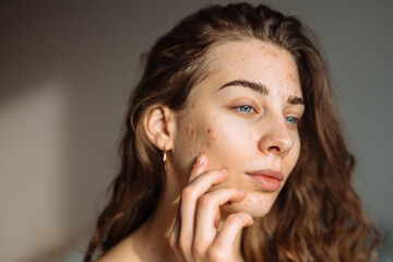 Portrait of a beautiful young woman with rash skin, scar, and red skin syndrome allergic to...