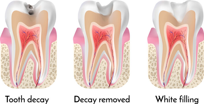Tooth treatment stages. Tooth decay, decay removed, white filling