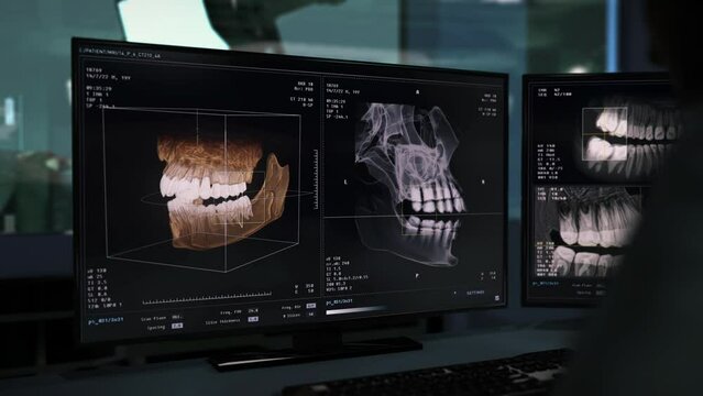 Medical software interface analysing the tooth using x-ray scan imaging. Medical program interface diagnosing the toothache. Medical dental tech interface studying the jaw before tooth removal.