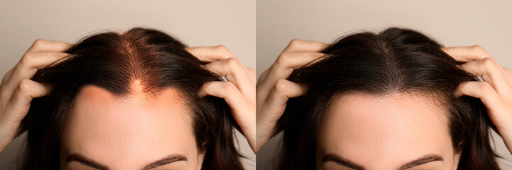 Woman before and after hair treatment with high frequency darsonval device on beige background,...