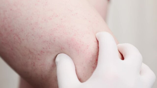 Close-up of woman's leg with red rash and vascular asterisks. Doctor hand shows problem area on female hip. Concept of varicosity and skin problem