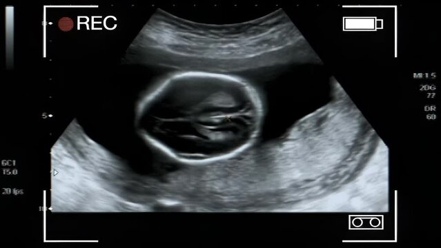 A collage of images of a fetus ultrasound screen for medical reference and study