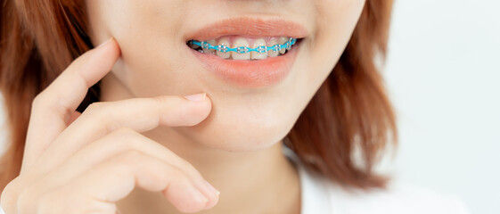 Treatment. Dental Care. Beautiful asian Woman Healthy Smile.Metal Brackets on Teeth. young Female...