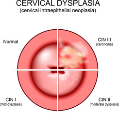 Cervical dysplasia. Close-up of a cervix. Cervical cancer
