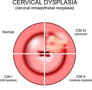 Cervical dysplasia. Close-up of a cervix. Cervical cancer