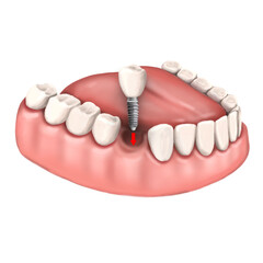 teeth and dental tools