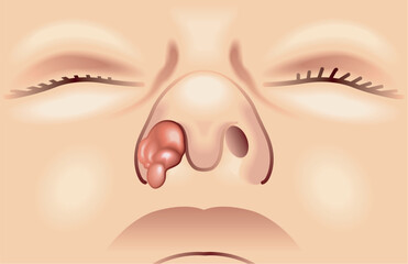 Medical illustration of a nasal tumor.