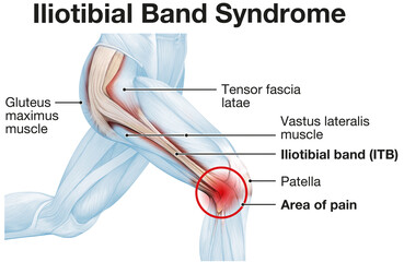 Iliotibial band syndrome, painful knee joint, inflammation or overuse. Illustration - obrazy, fototapety, plakaty