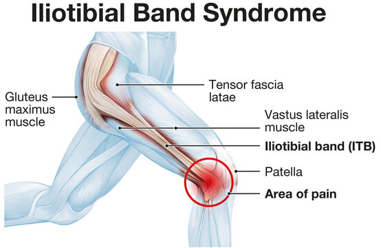 Iliotibial band syndrome, painful knee joint, inflammation or overuse. Illustration