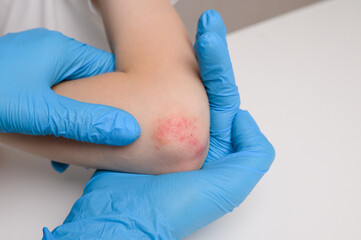  Doctor examines reddened, inflamed areas with scabs on child elbow, close-up. Child suffers from...