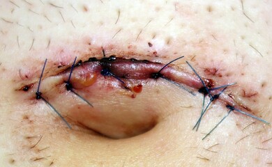 Stitches after umbilical hernia surgery