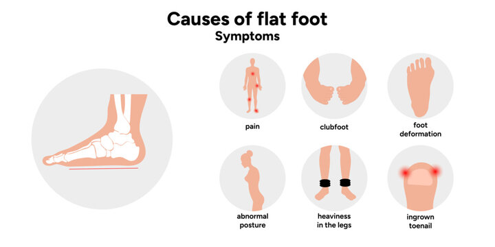 Causes of flat foot
