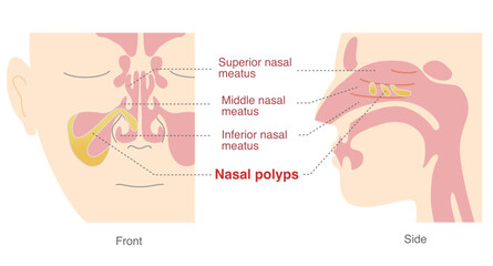 Obraz premium Illustration of nasal polyps in the sinuses from front and side views