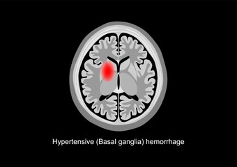 Basal ganglia hemorrhage brain scan illustration.