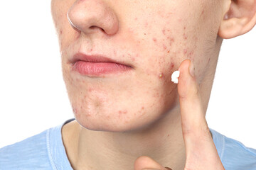 Obraz premium Young man with acne problem applying cosmetic product onto his skin on white background, closeup