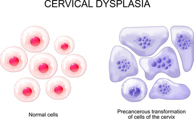 Cervical dysplasia. Cervical cancer - obrazy, fototapety, plakaty