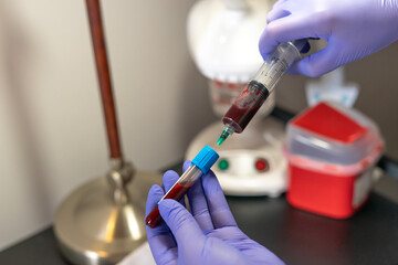 A person drawing a blood sample in a laboratory. The person is wearing a blue glove and is holding...
