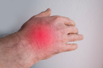 Close up male hand with dry skin damage. educational materials for medical students and...