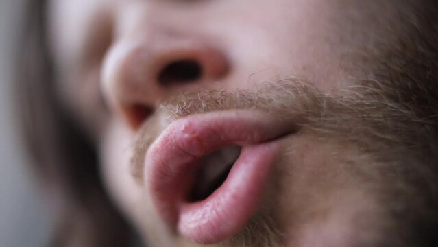 herpes on a man's lip, a viral disease on the lip