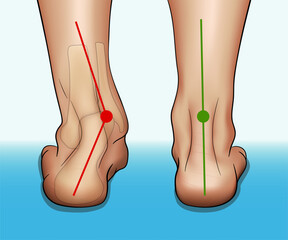 Vector illustration in realistic style depicting the medical problem of foot or ankle curvature or deformity, valgus deformity and flat feet problem. - obrazy, fototapety, plakaty