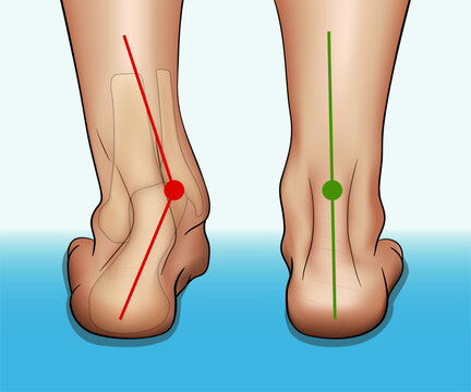 Vector illustration in realistic style depicting the medical problem of foot or ankle curvature or deformity, valgus deformity and flat feet problem.