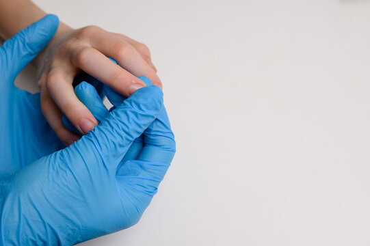Close-up of doctor wearing blue gloves examining child hand affected by viral warts Verruca vulgaris. Papillomavirus, HPV. Concept pediatric dermatology, skin diseases.