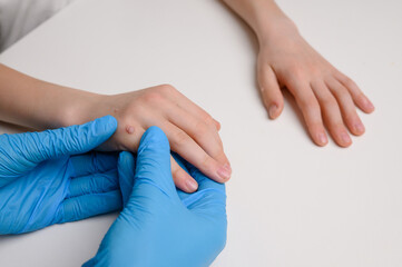 Dermatologist wearing blue gloves examines hand of child with many viral warts Verruca vulgaris,...