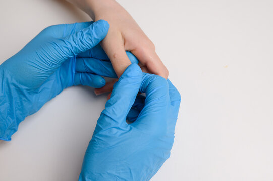  Doctor holds child hand with warts on thumb. Papillomavirus in child, close-up. Verruca vulgaris. HPV. Pediatric dermatology, diagnosis of nevus, benign neoplasms on human skin.